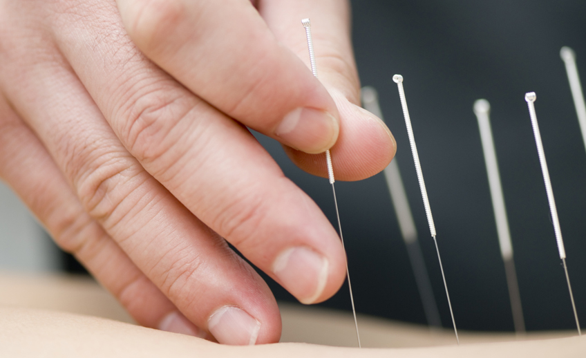 Acupuncture